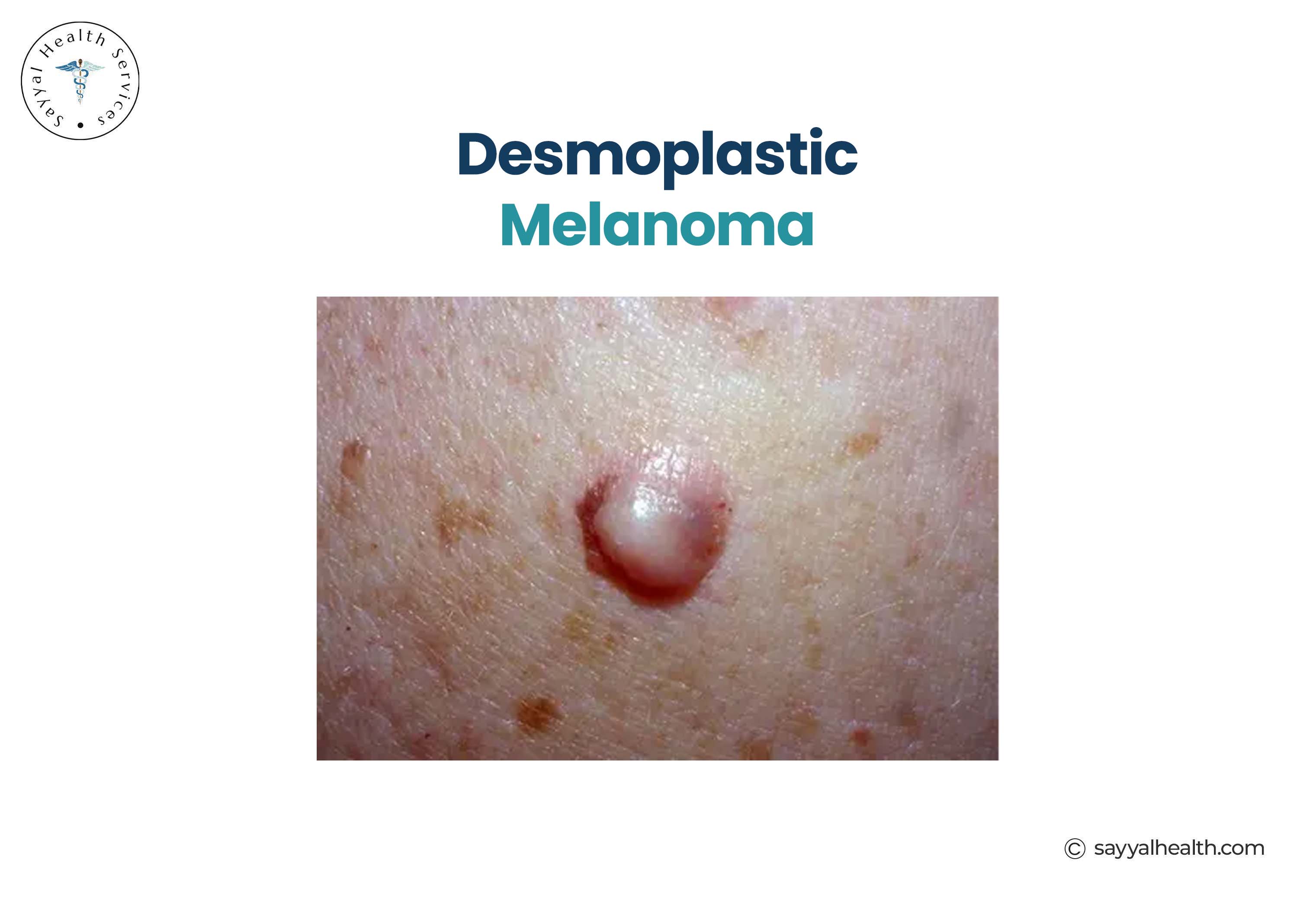 pictures of desmoplastic melanoma